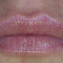 AFTER JUVEDERM